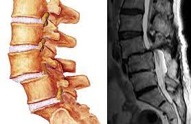 Lumbar Spondylosis (Artrithis) Treatment