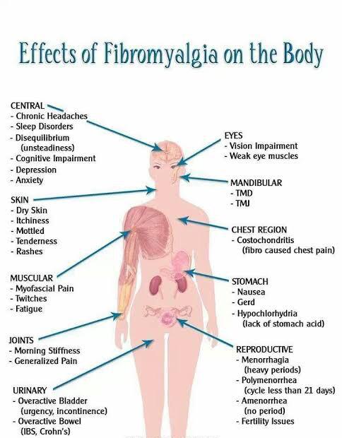 Highly Sort After Therapy For Fibromyalgia (Call Or WhatsApp - 08038089801)