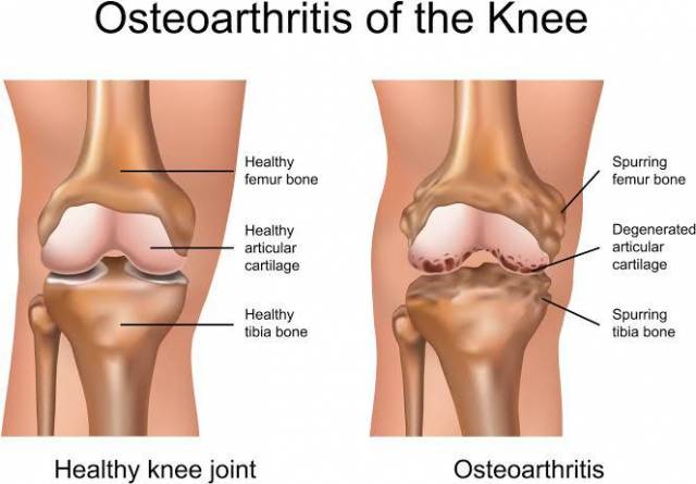 Speedy Healing From Osteoarthritis (Call Or WhatsApp - 08028589079)