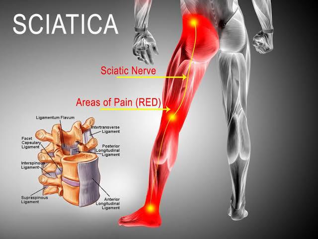 Therapeutic Treatment For Sciatica At Benign Evexia Center